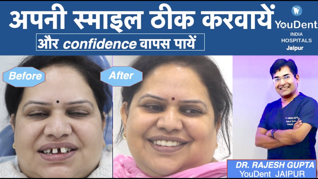 Teeth Spacing Treatment in a week  I YouDent India Hospital I Best Dental Hospital Rajasthan India