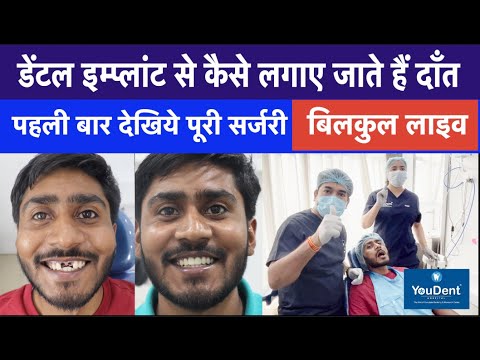 Complete Procedure of Dental implant | Best Teeth Implant Hospital in India | Implant By DR. Rajesh