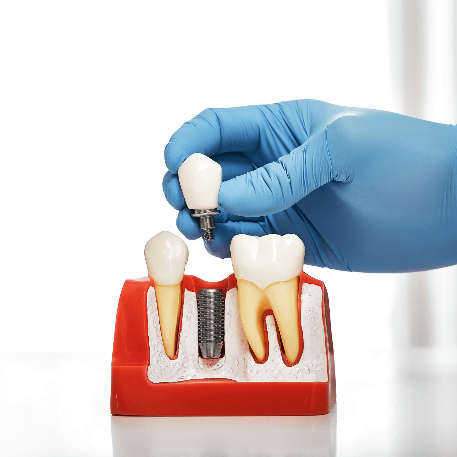 Best Dental Implant in India