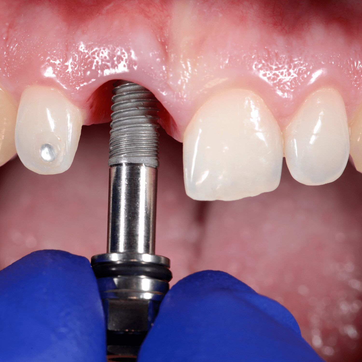 Best Dental Implant in India