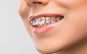 How to care for your teeth and gums when you have braces