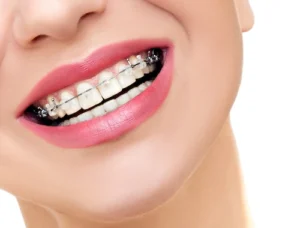 The Benefits of Orthodontic Treatment