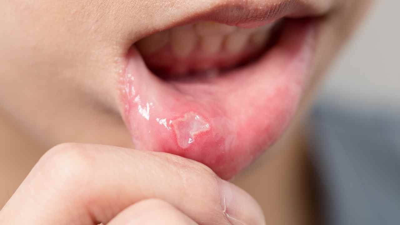 Mouth Ulcer Treatment - YouDent Hospital