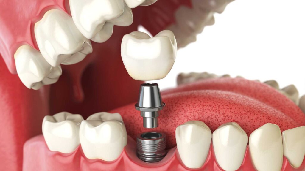 Dental Implants and Bridges