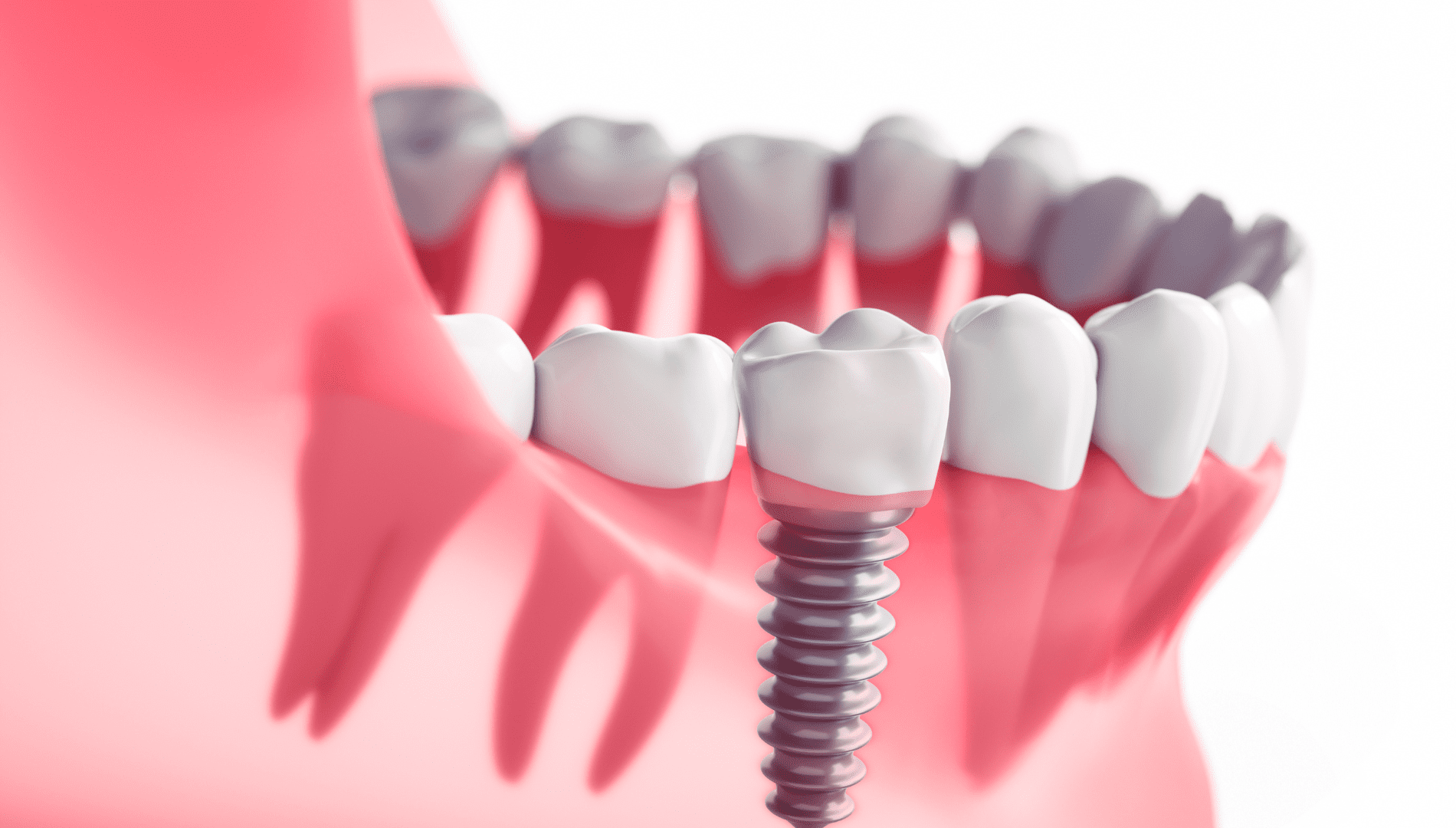 Read more about the article Cost of One Dental Implant – YouDent Hospital