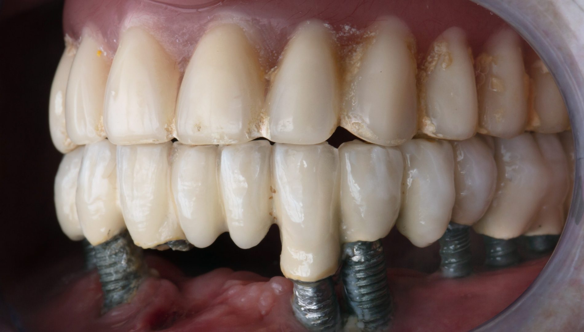 Read more about the article Explained All-on-4 Dental Implants Cost in India – YouDent Hospital