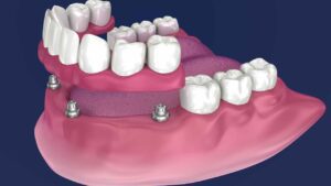 All on 4 dental implant in india