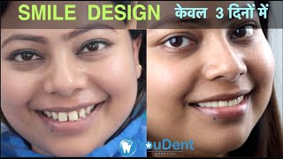 mqdefault - YouDent Hospital best dentist in Jaipur