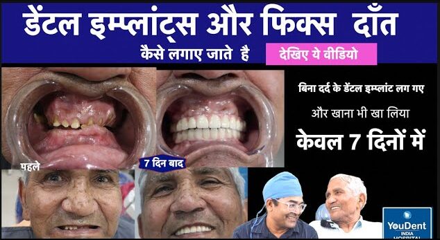 best dental implants in jaipur