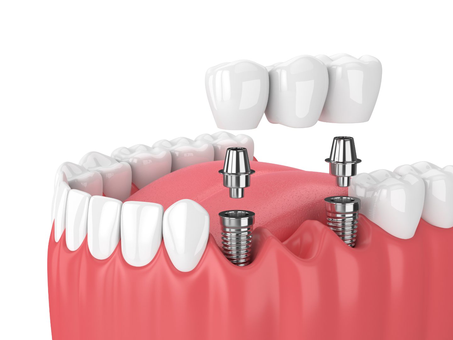 How Long Does It Take For The Full Procedure?
