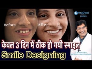 स्माइल को कैसे ठीक करे | Best Doctor for Smile Designing in India | Smile Makeover Treatment