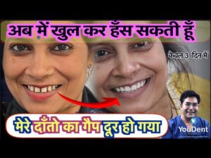 दाँतो के बीच गैप कैसे ठीक हो