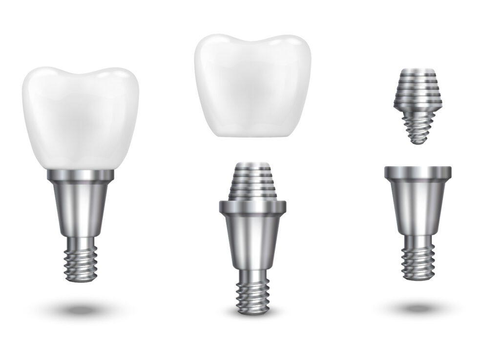 Does Health Insurance Cover Dental Implant Surgery?