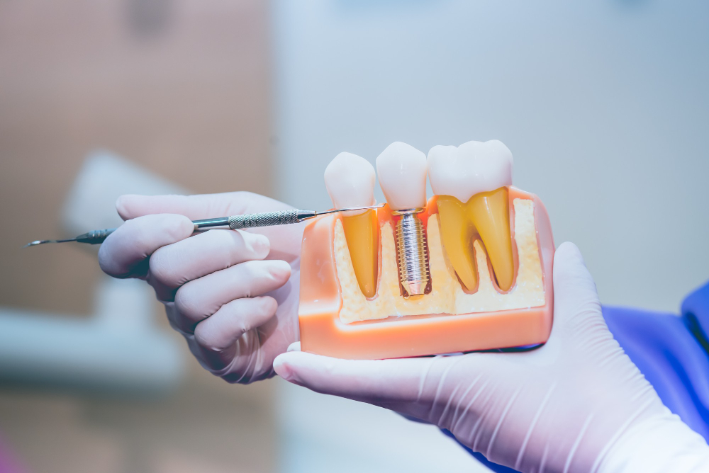 What are the benefits of dental implants?