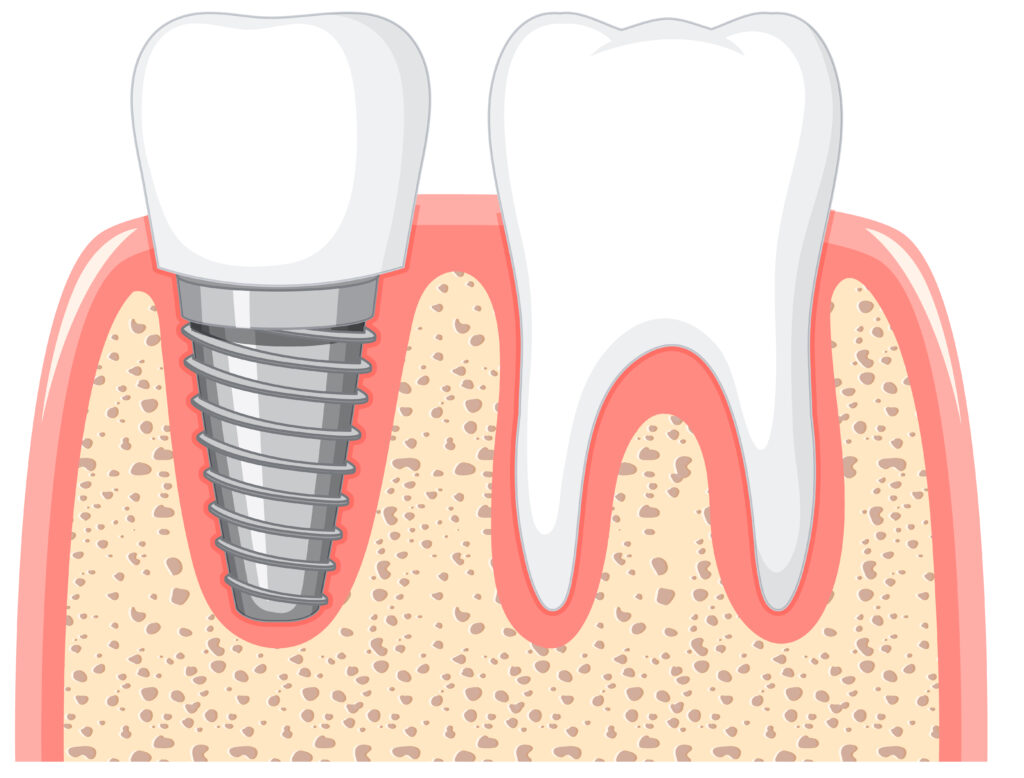 Can I Get A Dental Implant Years After Extraction?