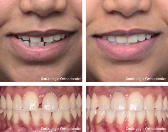दांतों के बीच गैप (Diastema) क्या होता है? कारण और इसका पूरा इलाज