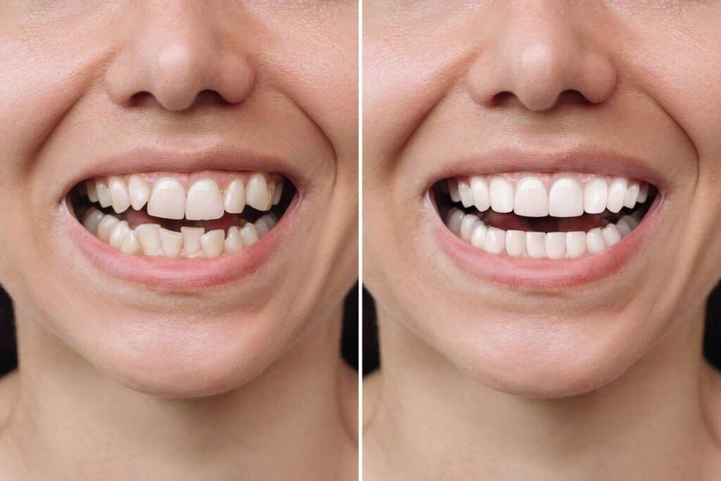 दांतों के बीच गैप (Diastema) क्या होता है? कारण और इसका पूरा इलाज
