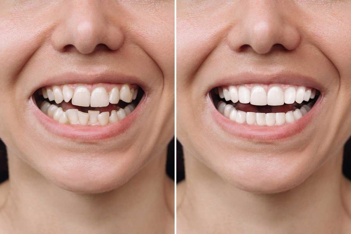 दांतों के बीच गैप (Diastema) क्या होता है? कारण और इसका पूरा इलाज