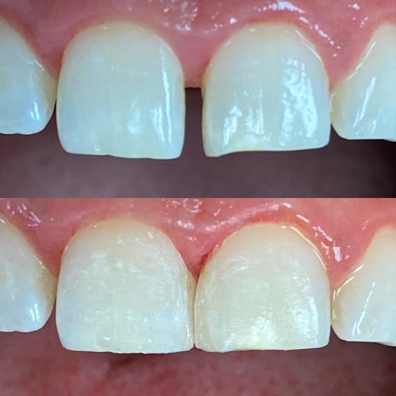 दांतों के बीच गैप (Diastema) क्या होता है? कारण और इसका पूरा इलाज