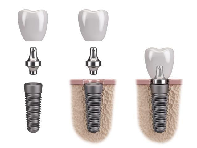 What Is Dental Implant Surgery?