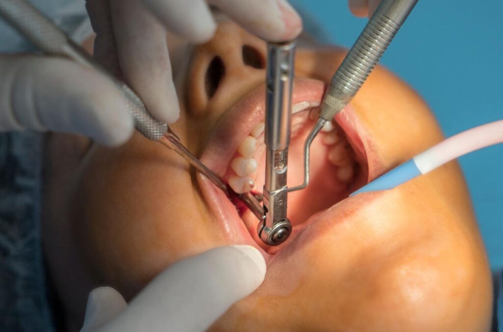 Close-up of a dental procedure: gloved hands using dental instruments and a drill inside a patient’s open mouth.