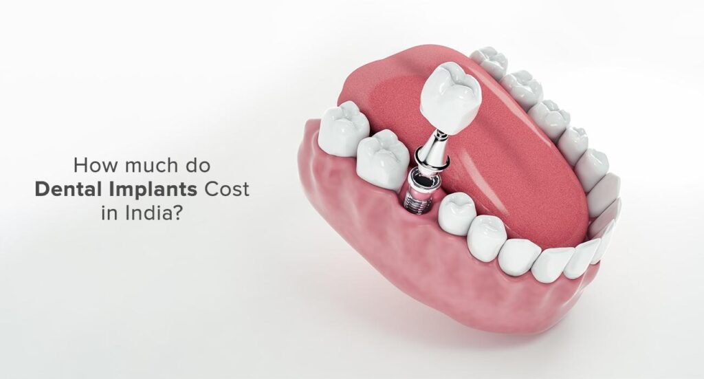 Are Dental Implants Expensive? How Much Do They Cost?