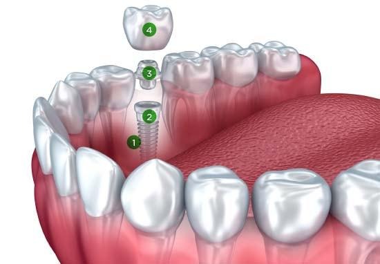 What Happens While Getting A Dental Implant?
