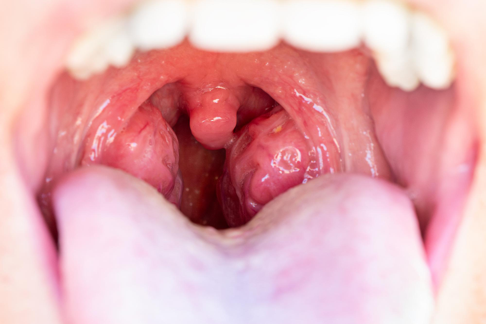 Close-up of an open mouth showing red, swollen tonsils and a pink throat, with a prominent uvula in the center, indicating inflammation.