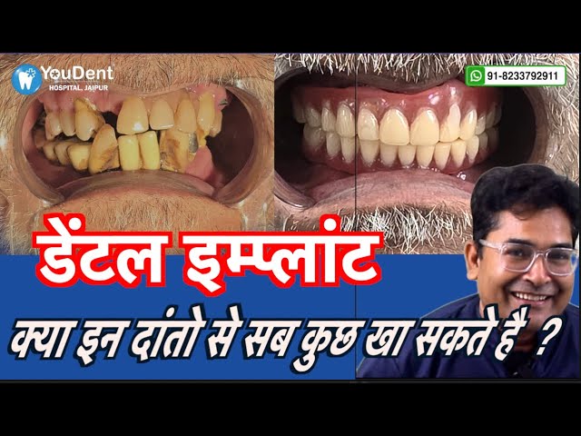 Split-screen dental before/after: decayed teeth on left, healthy smile on right, with red Hindi text 'डेंटल इम्प्लांट' and a smiling man on the right; YouDent Hospital Jaipur logo top-left.