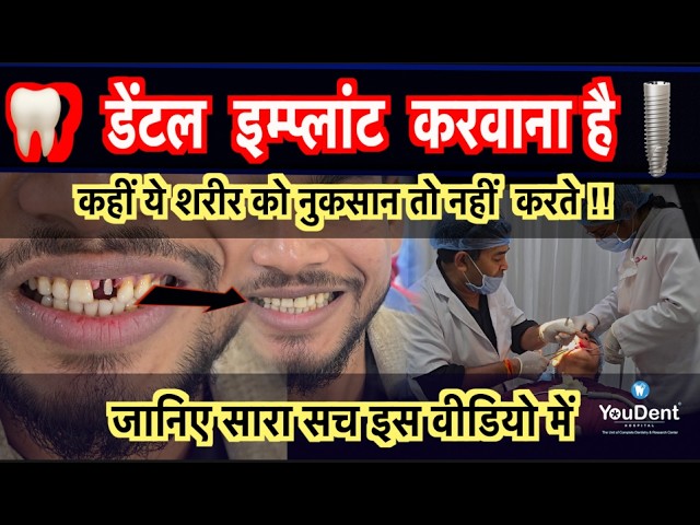 best-dental-implant