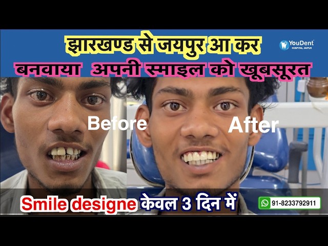 dental-implant